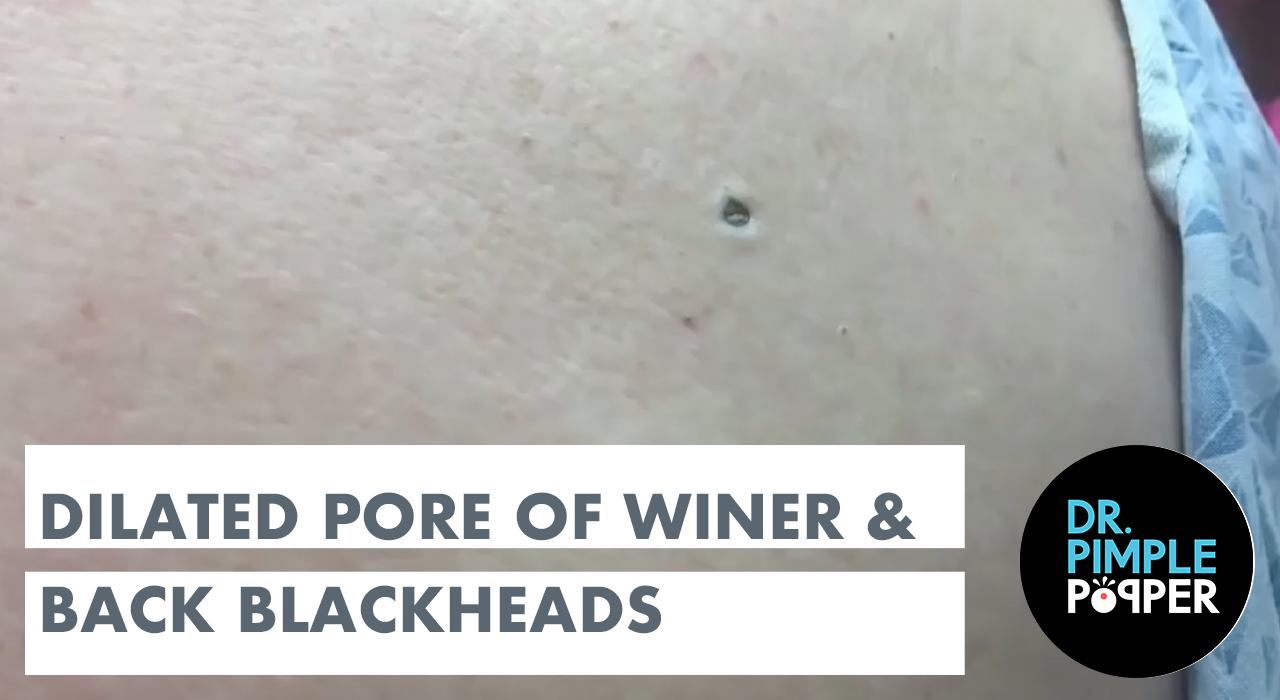 Dilated Pore Of Winer And Blackheads On The Back - Dr. Pimple Popper