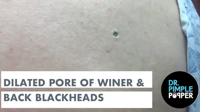 Dilated Pore of Winer and Blackheads ...