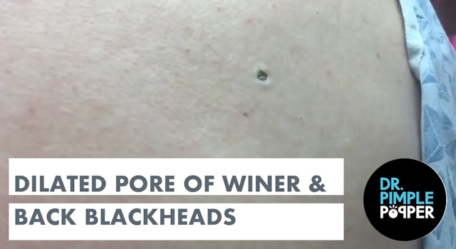 Dilated Pore of Winer and Blackheads on the Back