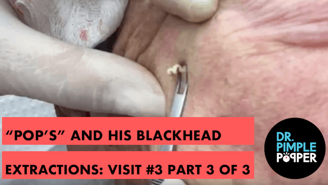 "Pops" and his blackhead extractions:...