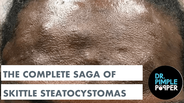 Dr. Pimple Popper Presents: The Complete Saga of Skittle Steatocystomas