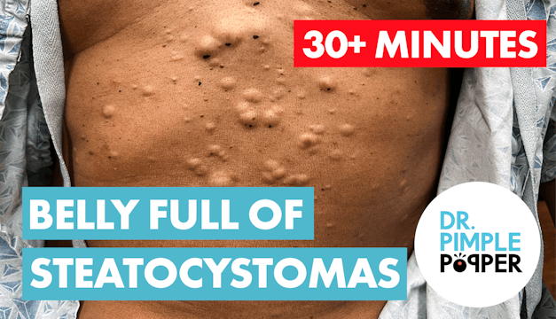 30+ Minutes with A Belly Full of Steatosystomas