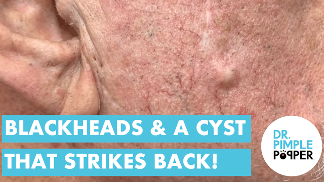BLACKHEADS & The Cyst that Strikes Back 