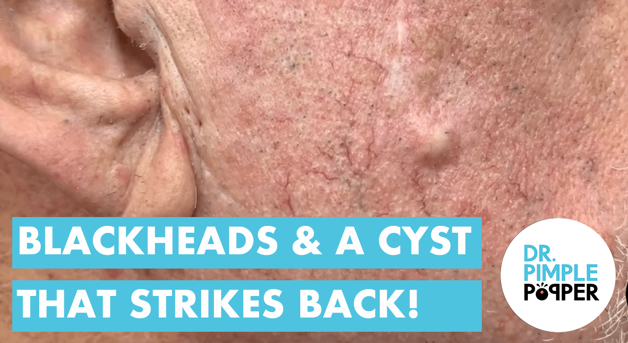 Blackheads And The Cyst That Strikes Back Recently Added Dr Pimple Popper