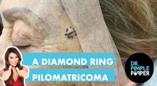 A Diamond Ring Pilomatricoma