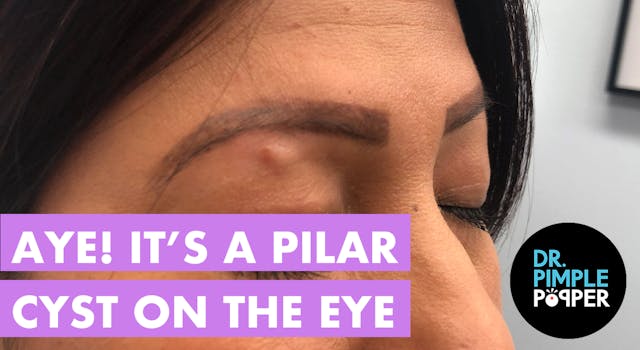 Aye! It's a Pilar Cyst on the Eye