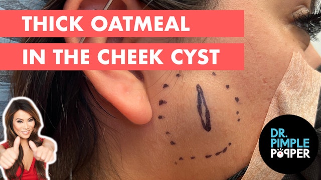 Thick Oatmeal in the Cheek Cyst
