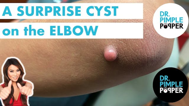A Surprise Cyst on the Elbow