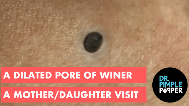 A Giant Blackhead in an 86 Year Old
