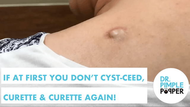 If at First you Don't Cyst-Ceed, Cure...