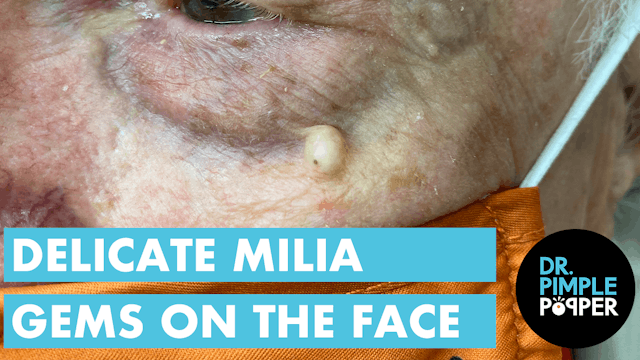 Delicate Milia Gems on the Face
