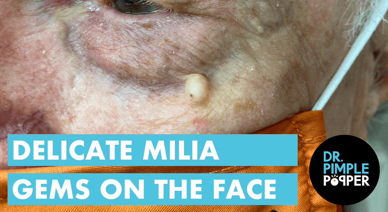 Delicate Milia Gems the Face Dr. Pimple Popper