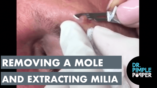Removing a Mole and Extracting Milia