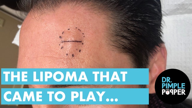 The Lipoma That Came to Play