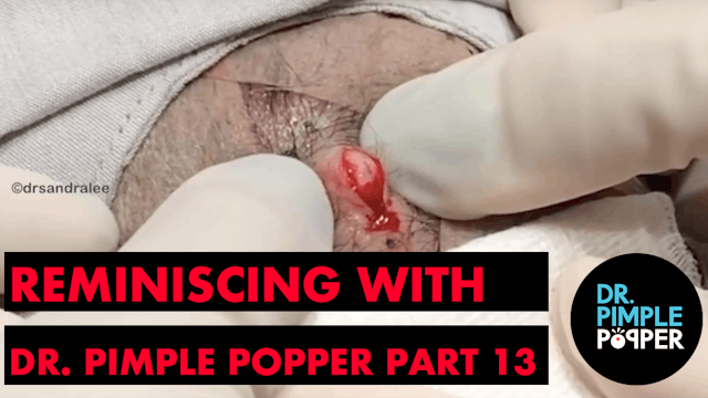 Reminiscing with Dr Pimple Popper TBT...