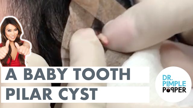 A Baby Tooth Pilar Cyst