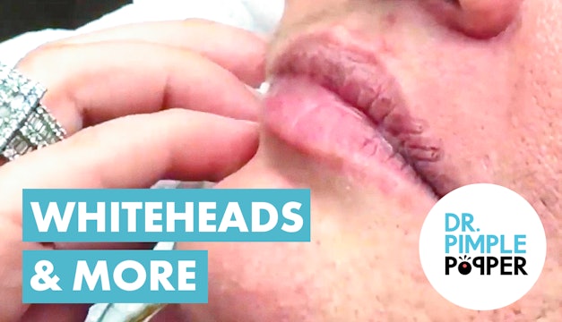 Soft Pops, Whiteheads, & More!