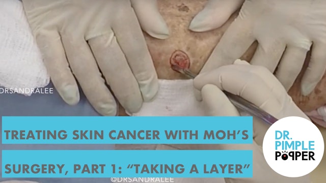 Treating Skin Cancer with Mohs surgery: Part 1, "Taking a layer", Filmed with GoPro