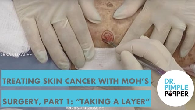 Treating Skin Cancer with Mohs surger...
