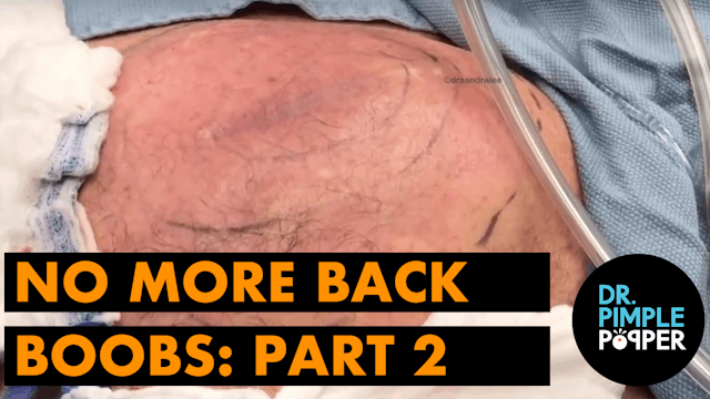 Part 2: No More Back Boobs