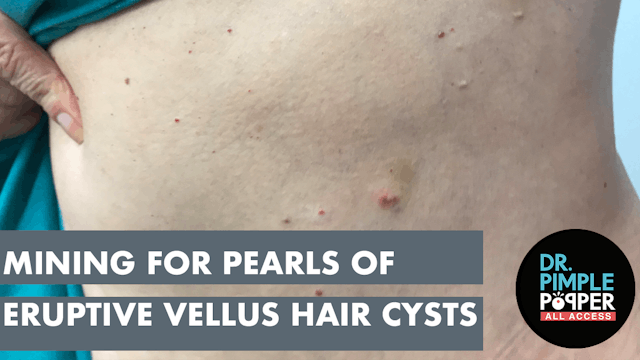 Mining for Pearls of Eruptive Vellus Hair Cysts