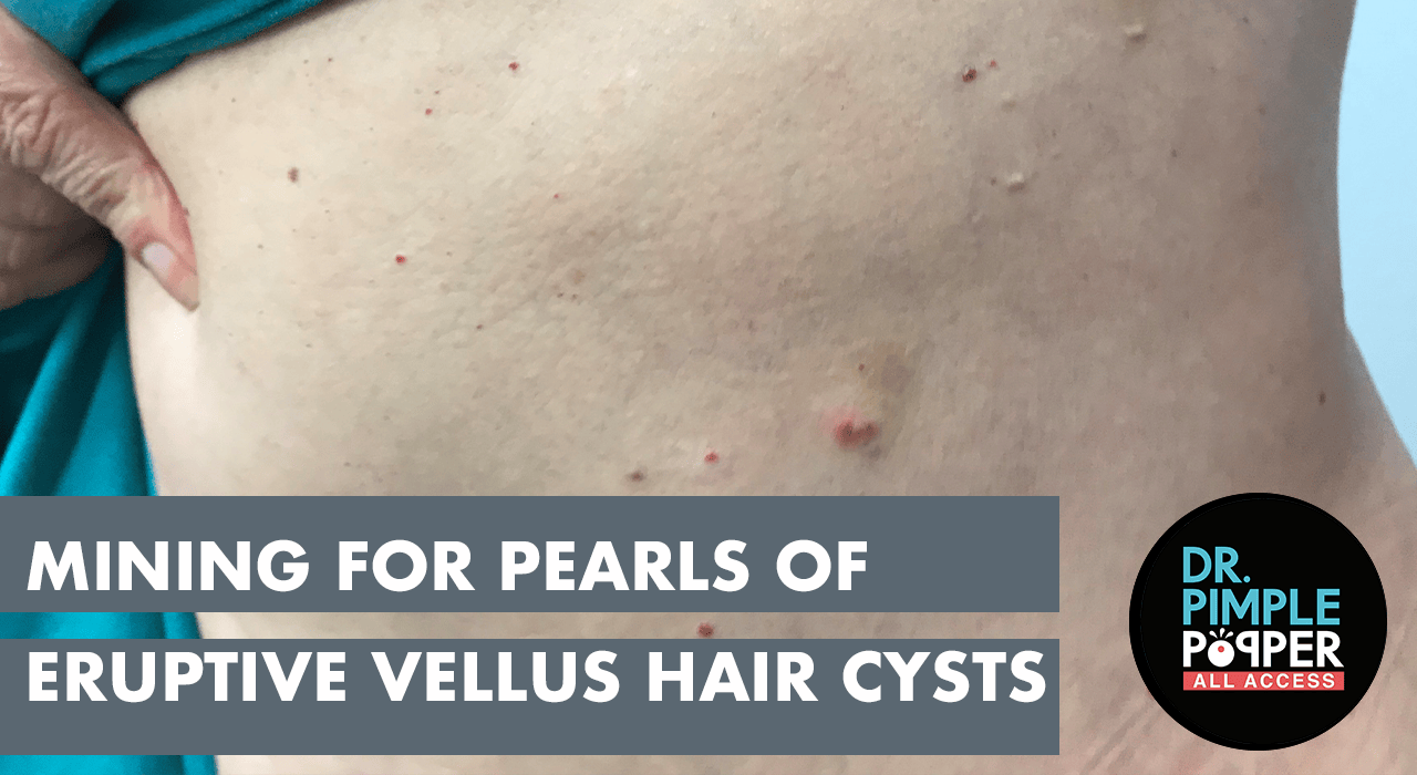 Mining for Pearls of Eruptive Vellus Hair Cysts Dr. Pimple Popper