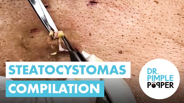 Steatocystomas Compilation