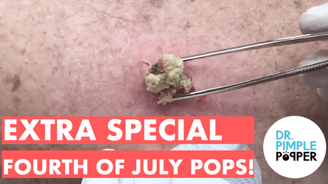 Dr. Pimple Popper Pops are Extra Special (4th of July Special)