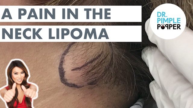 Queen of Pops Removes A Pain in the Neck Lipoma