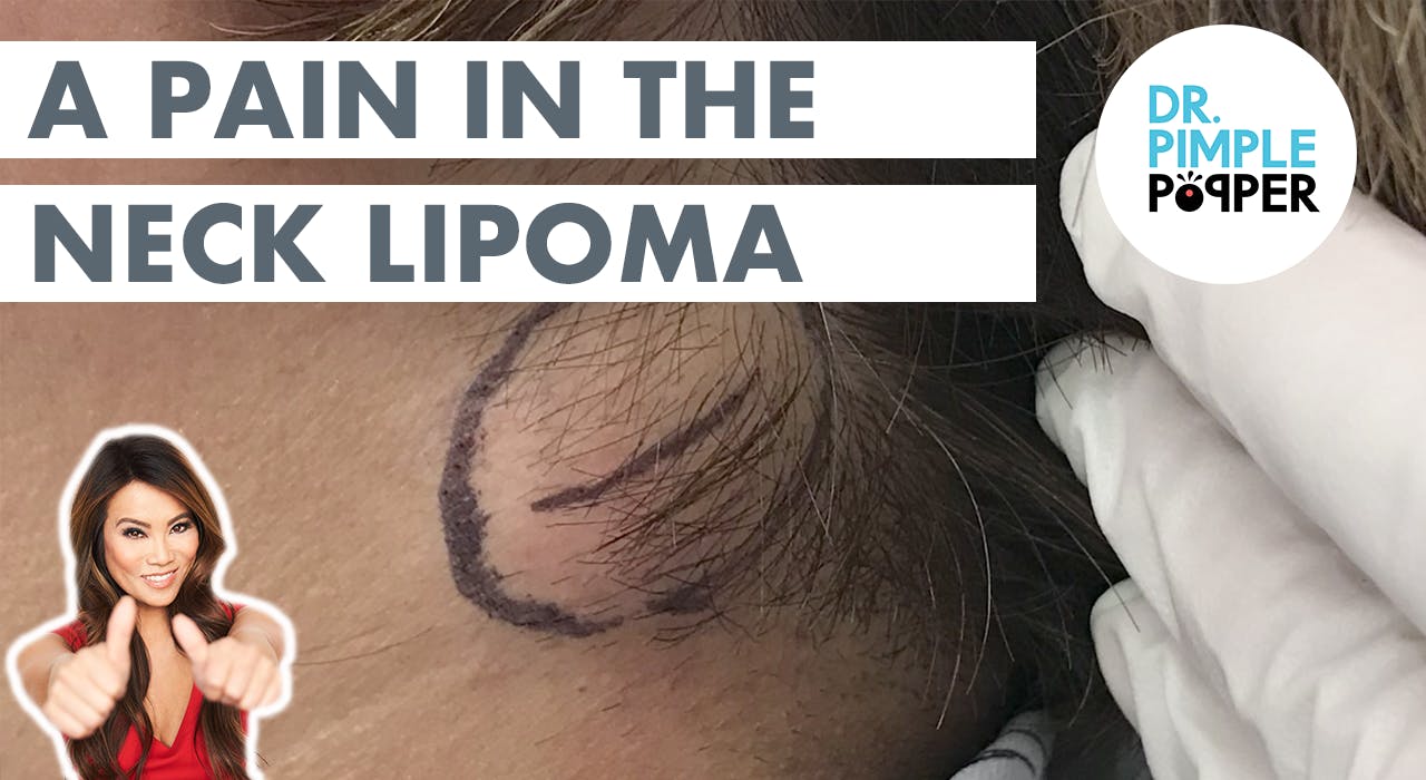 Queen of Pops Removes A Pain in the Neck Lipoma Lipoma Love Dr