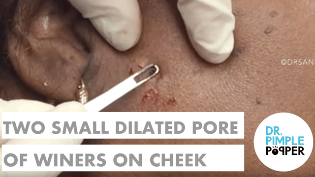 Two Small Dilated Pores of Winer on the Cheek