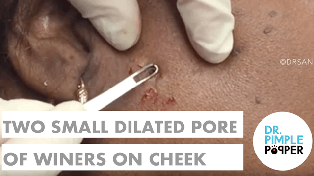 Two Small Dilated Pores of Winer on t...