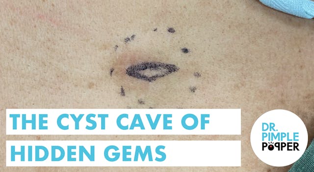 The Cyst Cave of Hidden Gems