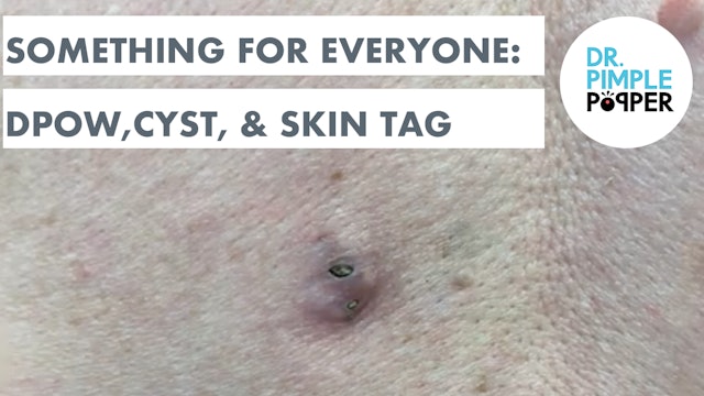 Something for Everyone: DPOW, Cyst, & Skin Tag