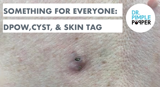 Something for Everyone: DPOW, Cyst, & Skin Tag