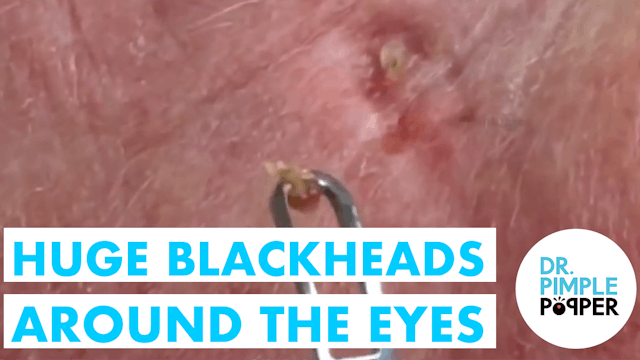 Huge blackheads around the eyes: sola...