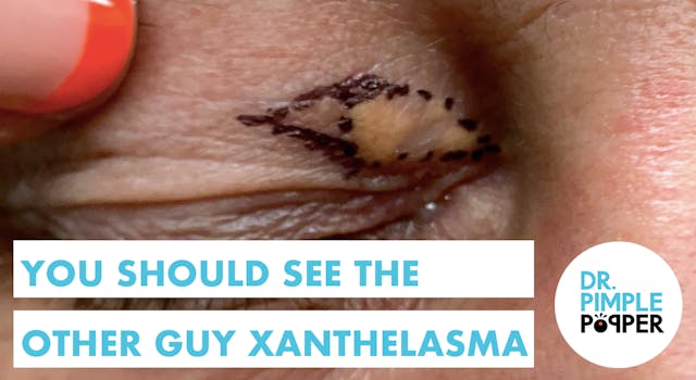 You Should See the Other Guy Xanthelasma