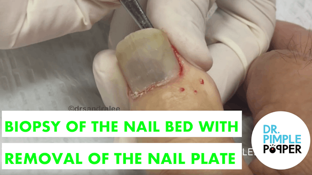 Biopsy of the Nail Bed with Removal of the Nail Plate: Nail Avulsion