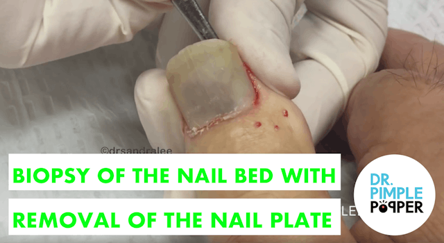 Biopsy of the Nail Bed with Removal o...