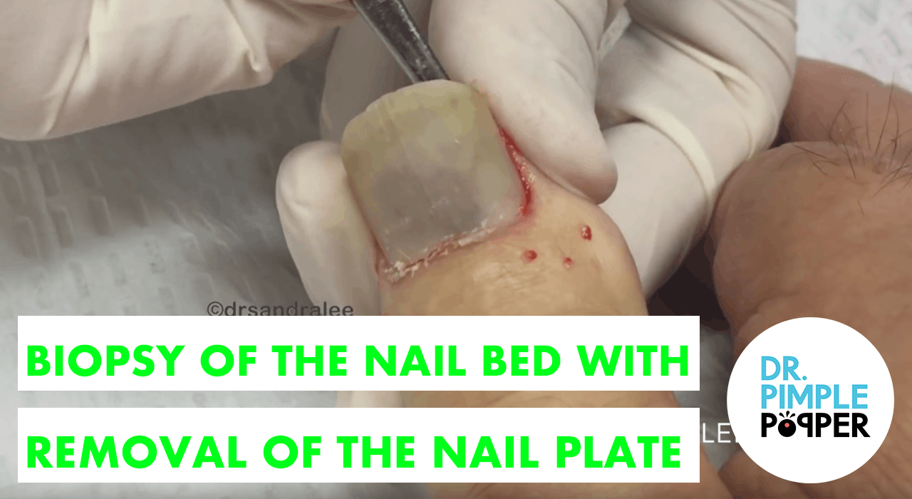 Biopsy of the Nail Bed with Removal of the Nail Plate Nail Avulsion