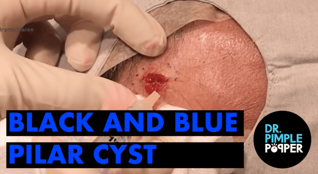 Black and Blue Pilar Cyst