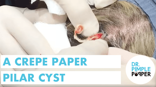 A Crepe Paper Pilar Cyst