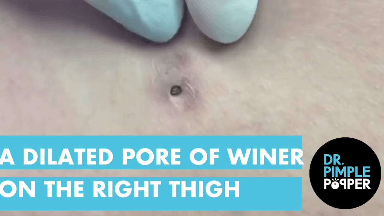 Dilated Pore Of Winer A Dilated Pore of Winer on the Right Lateral Thigh - Dr. Pimple Popper