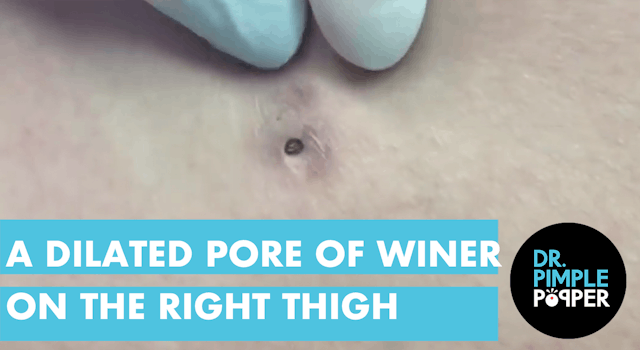 A Dilated Pore of Winer on the Right Lateral Thigh
