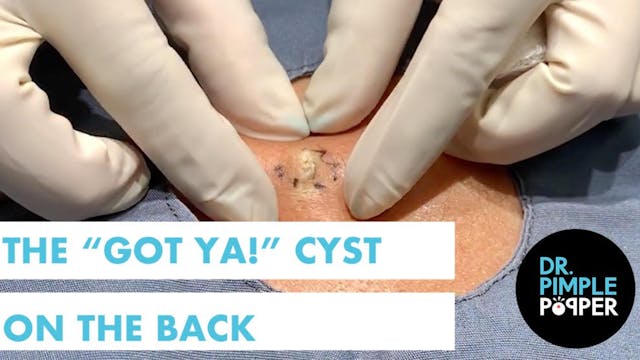 The "Got Ya!" Cyst on the Back