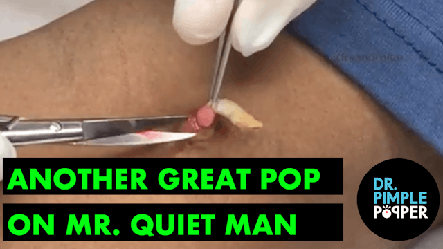ANOTHER Great POP on Mr. Quiet Man: Dr Pimple Popper