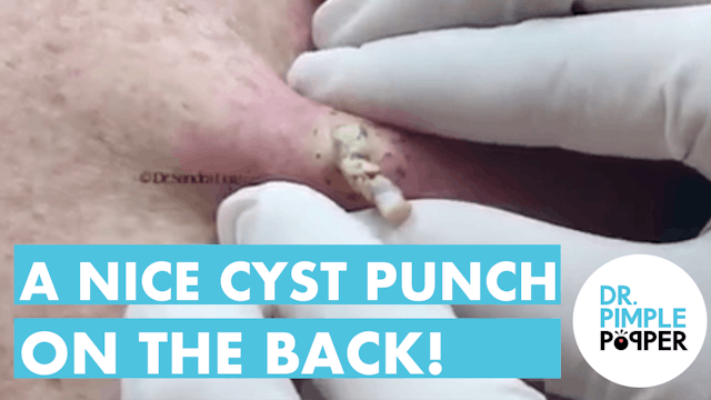 A nice little cyst punch on the back