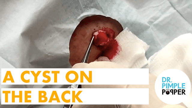 Here's that cyst on the back that I p...