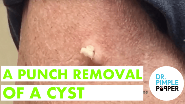 Punch Removal of a Cyst! With Dr. Pim...