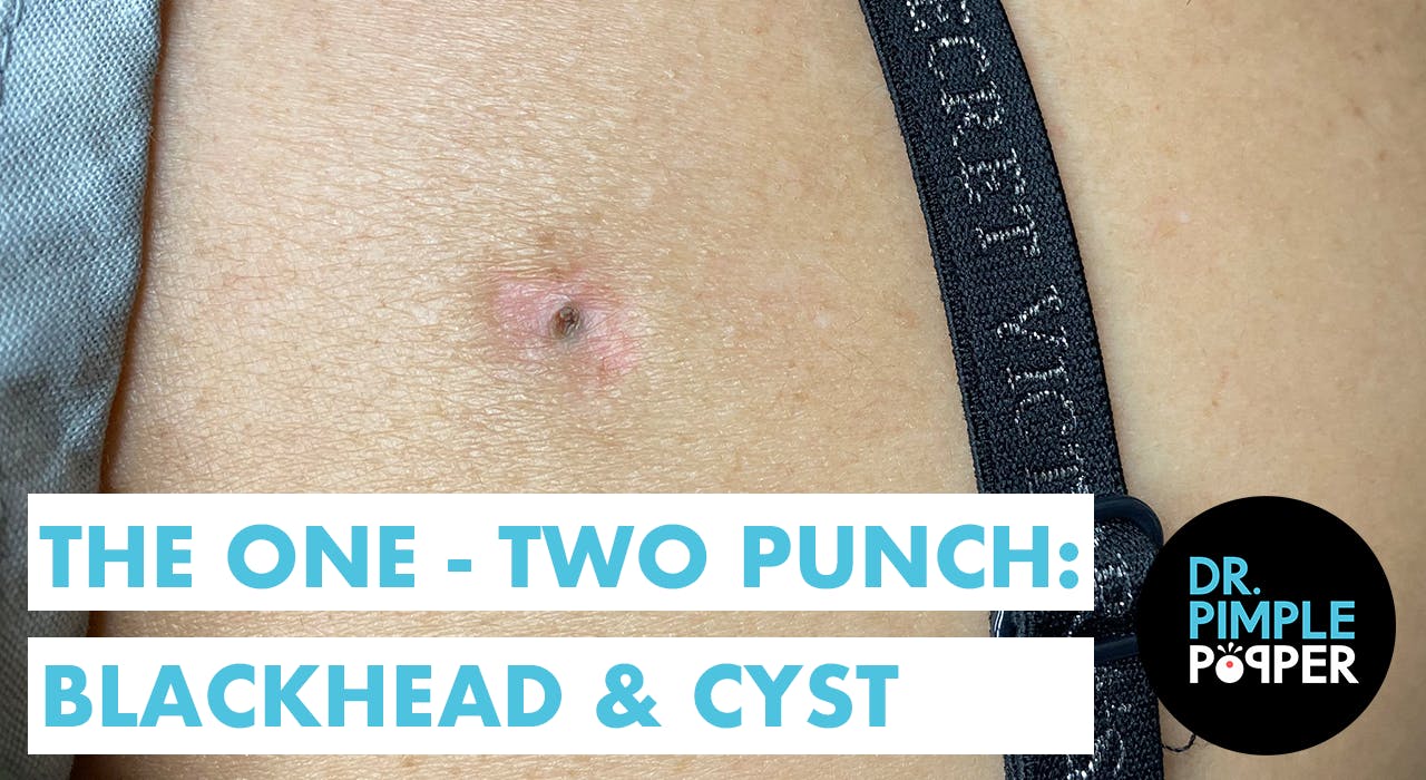 The Punch Blackhead & Cyst Recently Added Dr. Pimple Popper